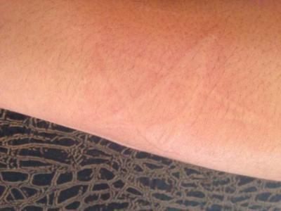 幼儿麻疹的预防