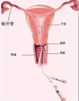 做输卵管通液什么时候做合适