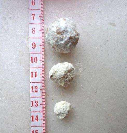 尿黄多吃什么食物好