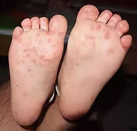 小孩疱疹性咽峡炎和手足口病区别