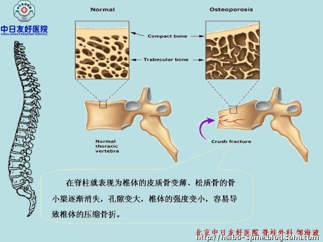 宝宝骨折的正确方法