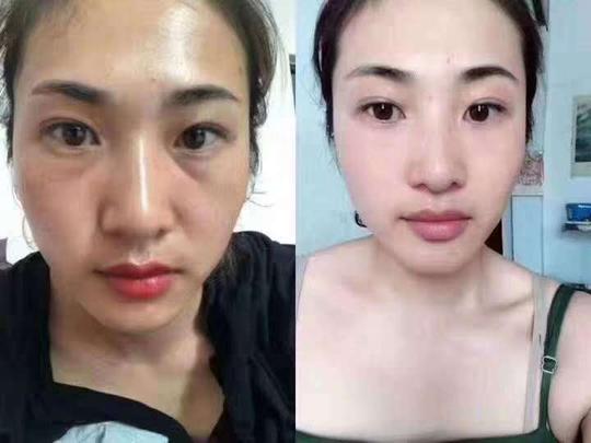 红球干细纹胞丰脸眼袋凹陷法令纹抬头纹真性皱纹葡聚多肽