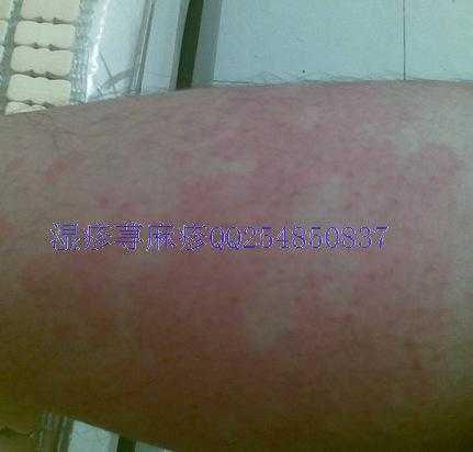 慢性荨麻疹可以根治吗?