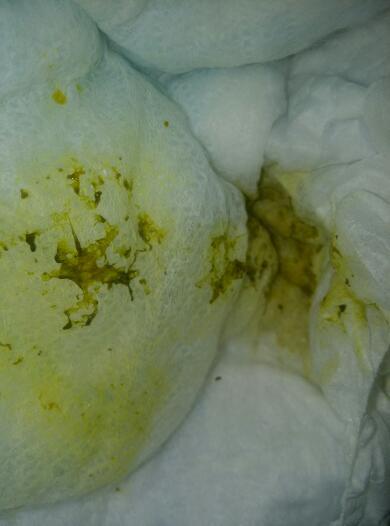 孩子受寒有些什么症状