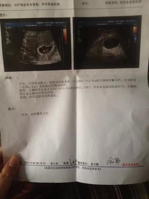 怀孕4周b超没有胎心胎芽
