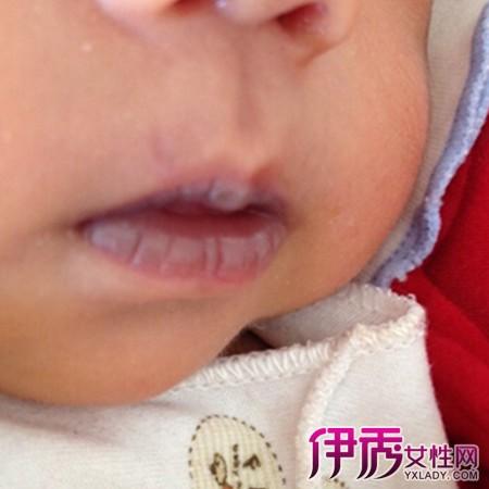 婴儿嘴唇发紫的原因
