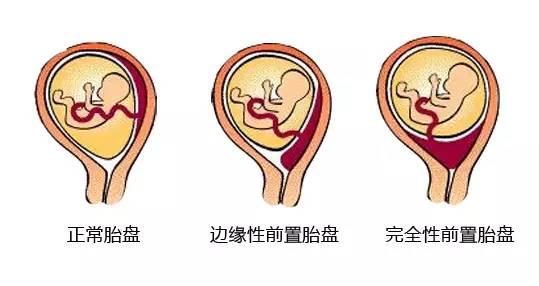 胎盘位于什么位置比较好