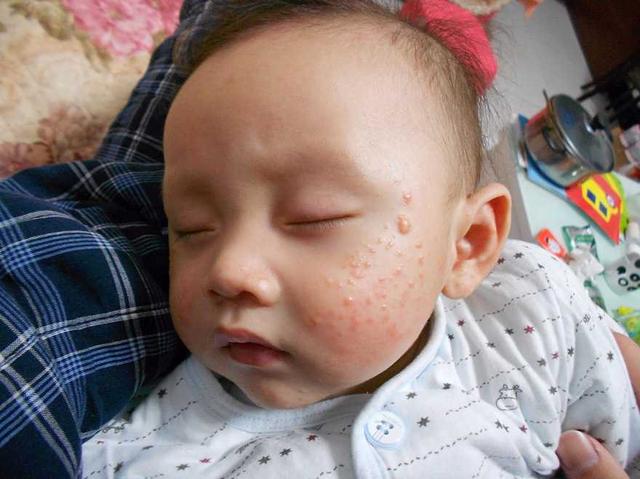 孩子湿疹的最佳治疗办法是什么