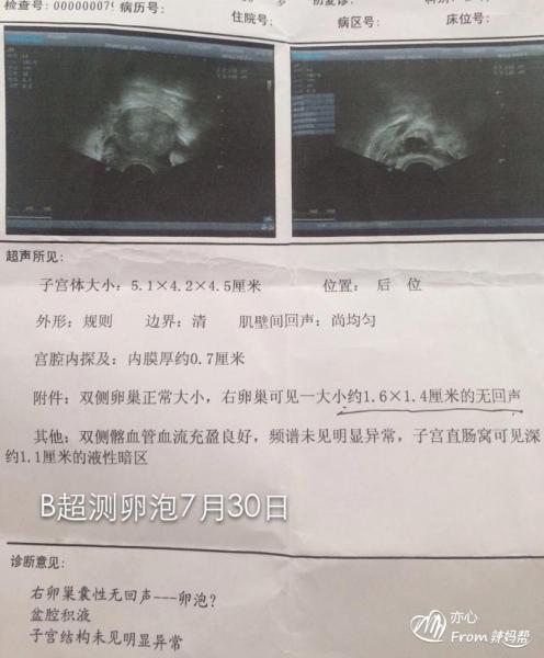 卵泡小内膜薄是什么原因