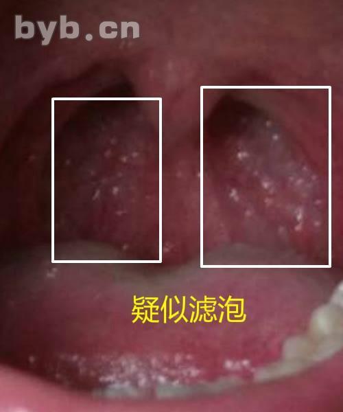 宝宝不同颜色的痰代表的意义是什么