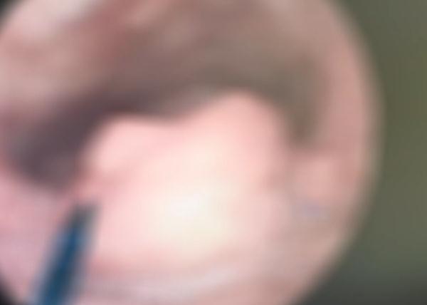 儿童会厌炎有什么症状