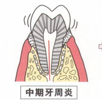 九成以上成年人有牙周疾病