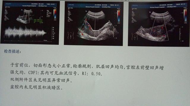 诊断性刮宫后多久复查