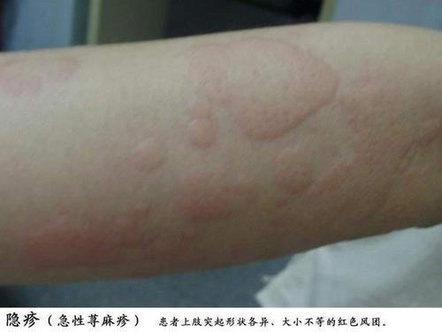 宝宝起荨麻疹怎么办