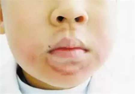 孩子经常喜欢舔嘴唇怎么办