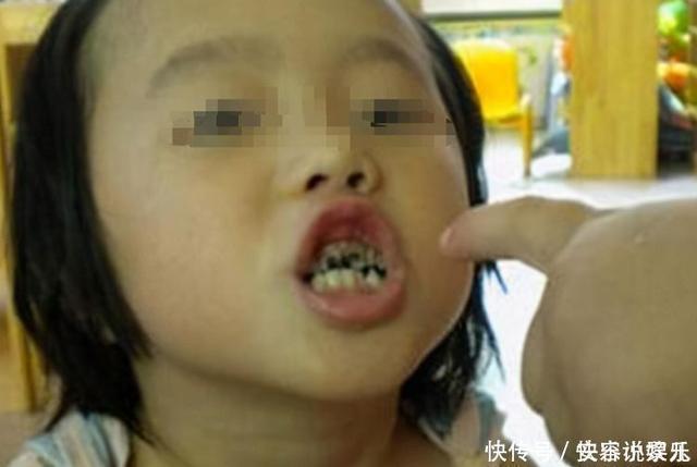 孩子换牙起应该怎么护理