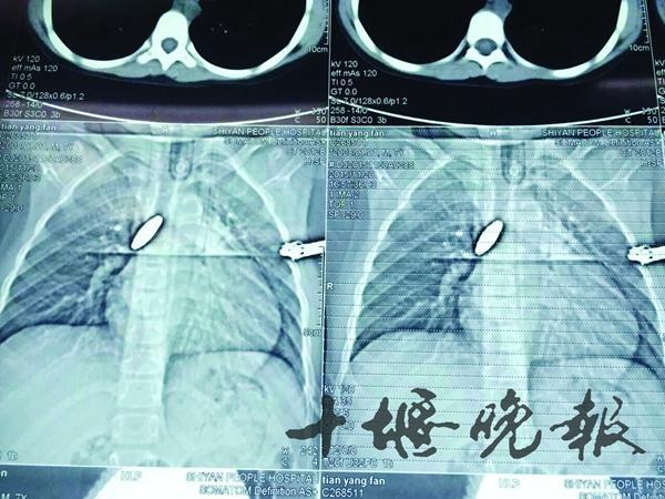 宝宝误吞异物怎么办