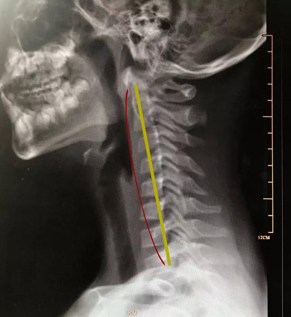 怎么判断有没有颈椎反弓