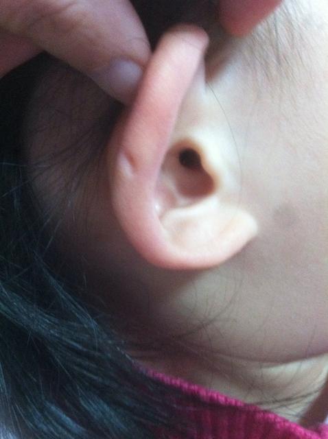 孩子耳朵上面有小孔是什么 小孩耳朵上面有个小孔是什么意思