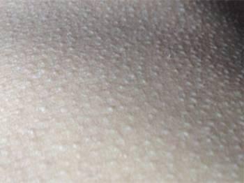 大腿内侧瘙痒的原因是什么?