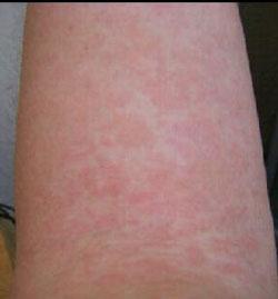 婴儿玫瑰疹怎么治疗