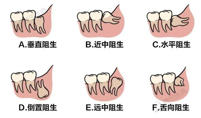 医生建议拔牙是什么原因