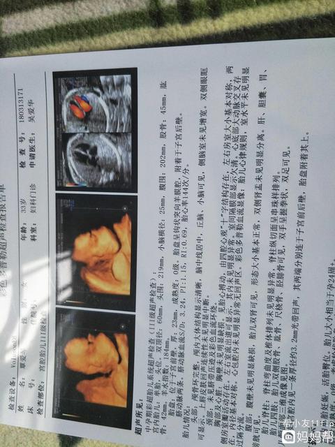 四维彩超怎么能分辨男女