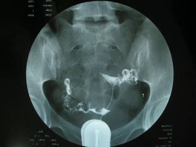 X光输卵管造影