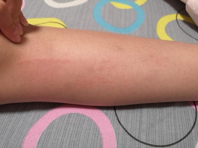 宝宝被蚊虫叮咬了红肿发痒怎么办