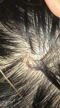 形容掉发的句子儿童头皮有结痂还掉头发