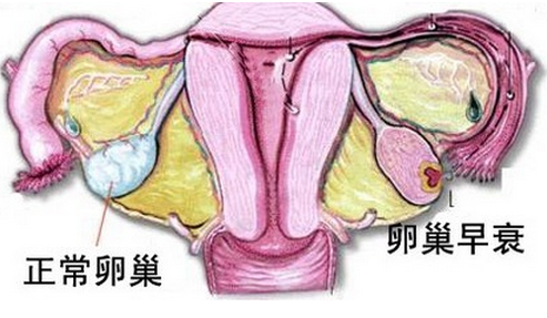 卵巢早衰的如何治疗