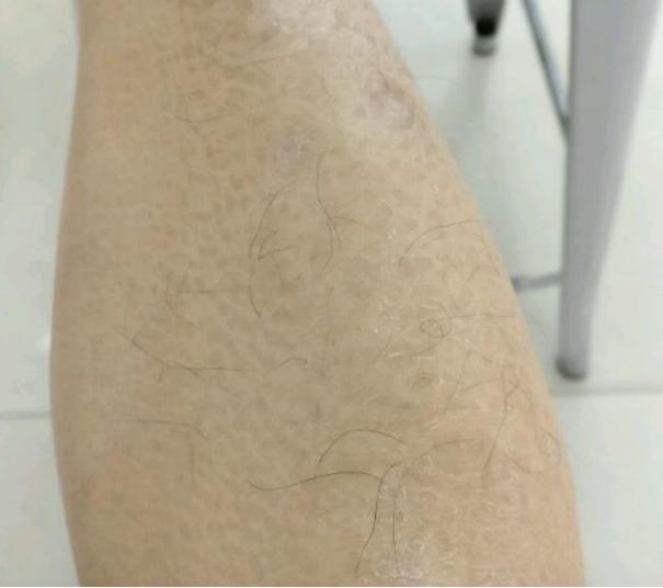 盘点冬季婴幼儿皮肤问题