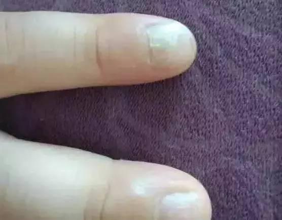 疱疹性咽峡炎和手足口病有什么不同