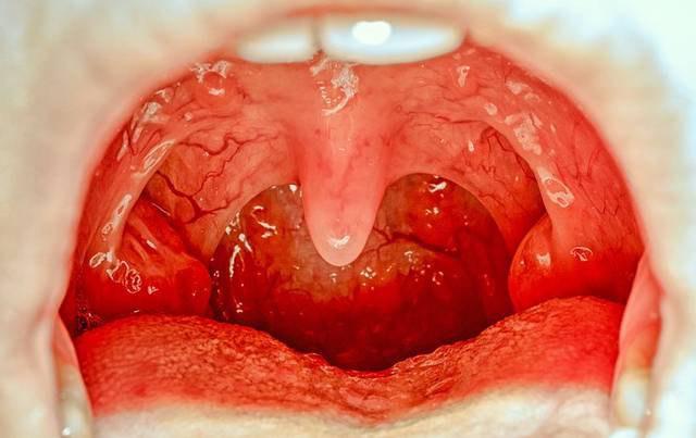 为什么孩子的扁桃体炎会反复发呢