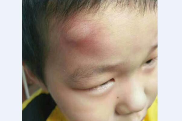 宝宝被蚊子咬了怎么消毒