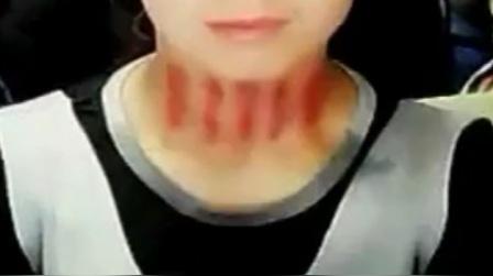 揪痧女520