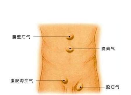 宝宝疝气的症状表现
