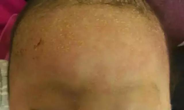 春季预防湿疹