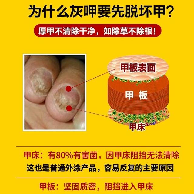 小孩甲沟炎用什么药好