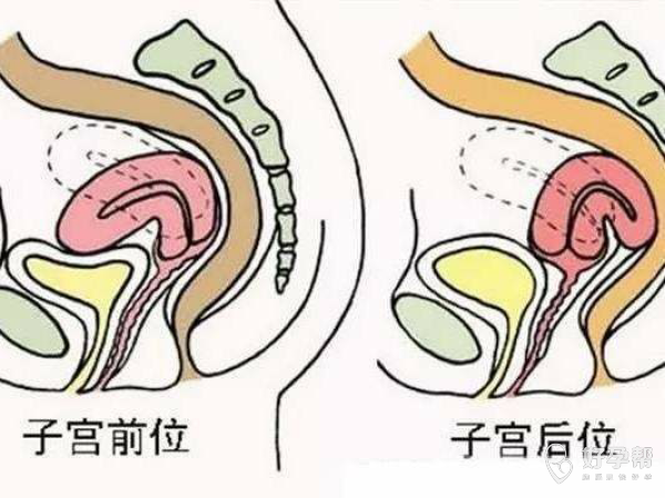 子宫后位会有哪些影响