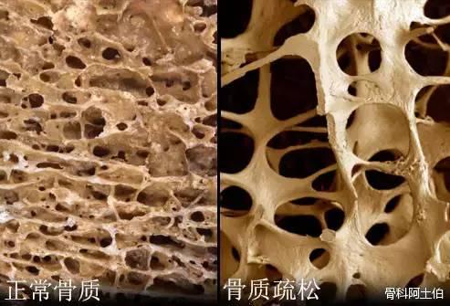 生孩子后骨质疏松