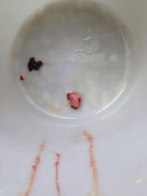 哪些人不适合做药物流产