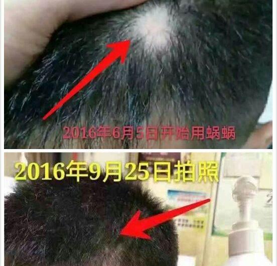 儿童为什么会脱发