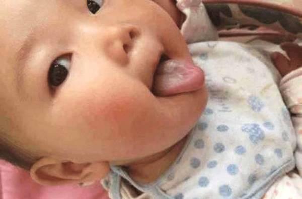 孩子积食有哪些症状怎么办