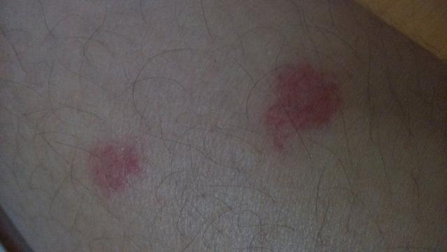 蚊子咬在人身体哪个部位最痒