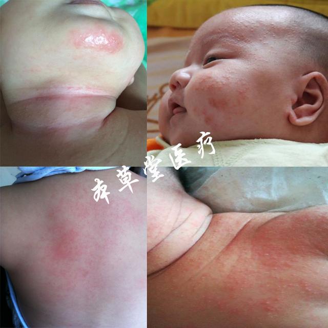 宝宝红屁屁o型腿