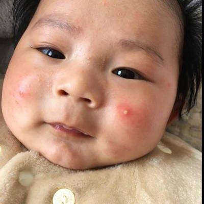 新生儿脸上起湿疹怎么治疗