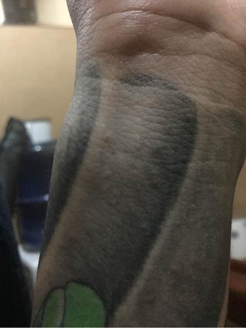 宝宝长了传染性软疣怎么办