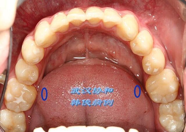 孩子都要吃打虫药吗