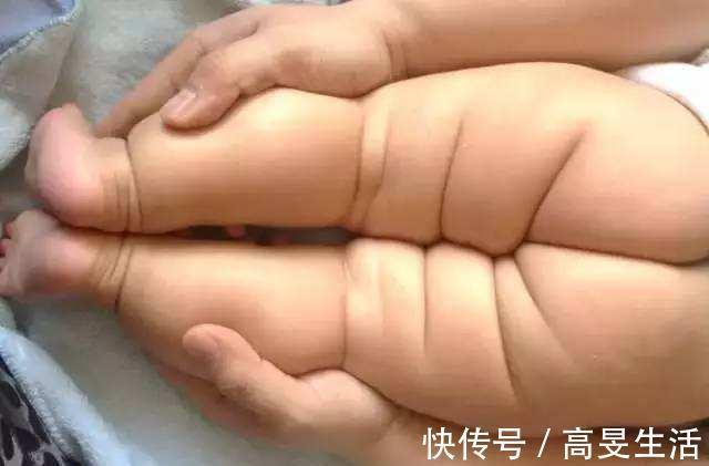 婴儿臀纹不对称一定是髋关节脱位吗